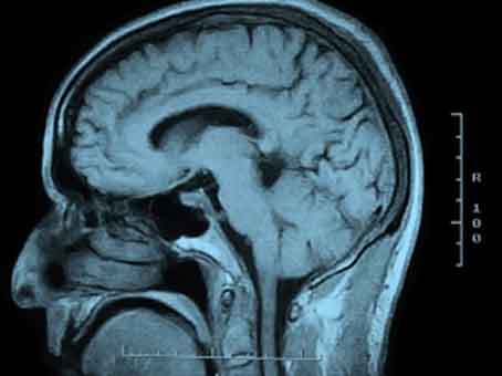 Foto de Menopausa desencadeia alterações metabólicas no cérebro que podem causar Alzheimer
